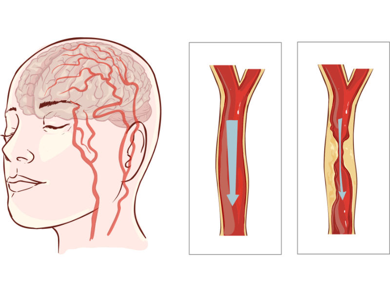 Durchblutungsstörungen: Erklärgrafik für Schlaganfall